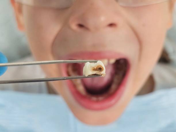 Best Emergency Dental Care for Broken or Chipped Teeth in Morehead, KY
