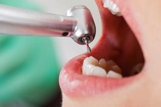 Best Emergency Tooth Extraction in Morehead, KY